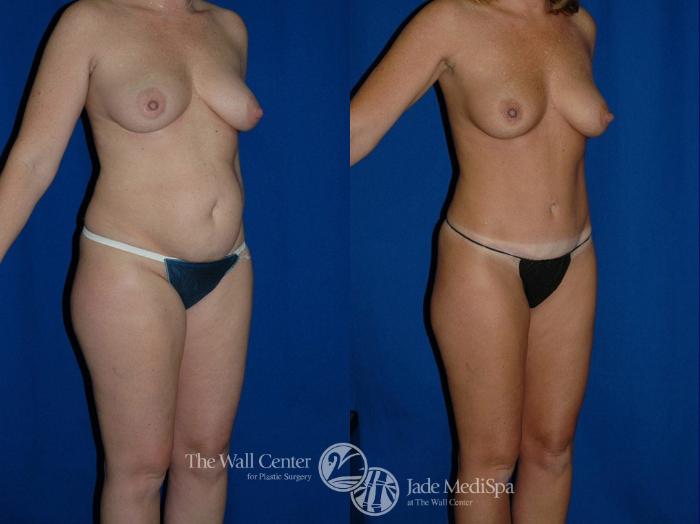 Before & After Tummy Tuck Case 16 View #3 View in Shreveport, LA