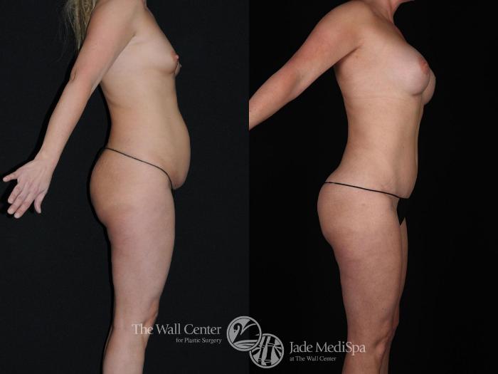 Before & After Tummy Tuck Case 249 View #2 View in Shreveport, LA