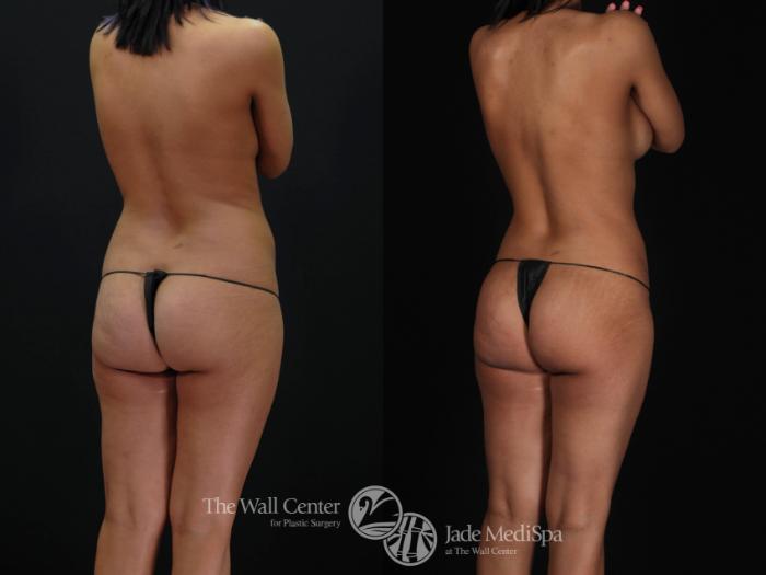 Before & After Tummy Tuck Case 479 View #5 View in Shreveport, LA