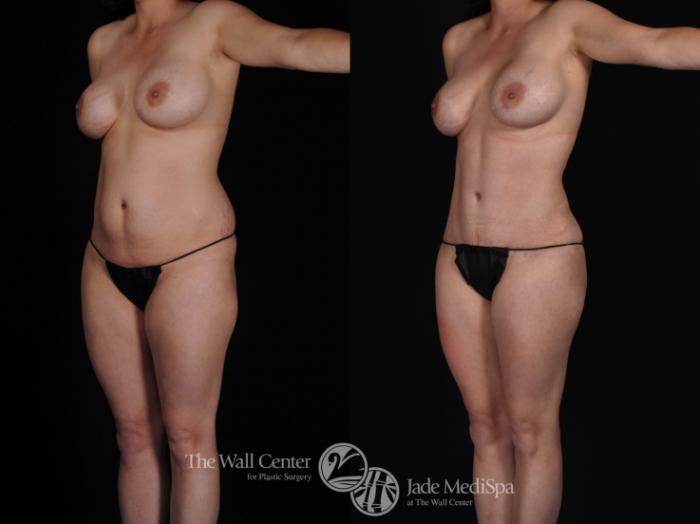 Before & After Tummy Tuck Case 496 View #3 View in Shreveport, LA