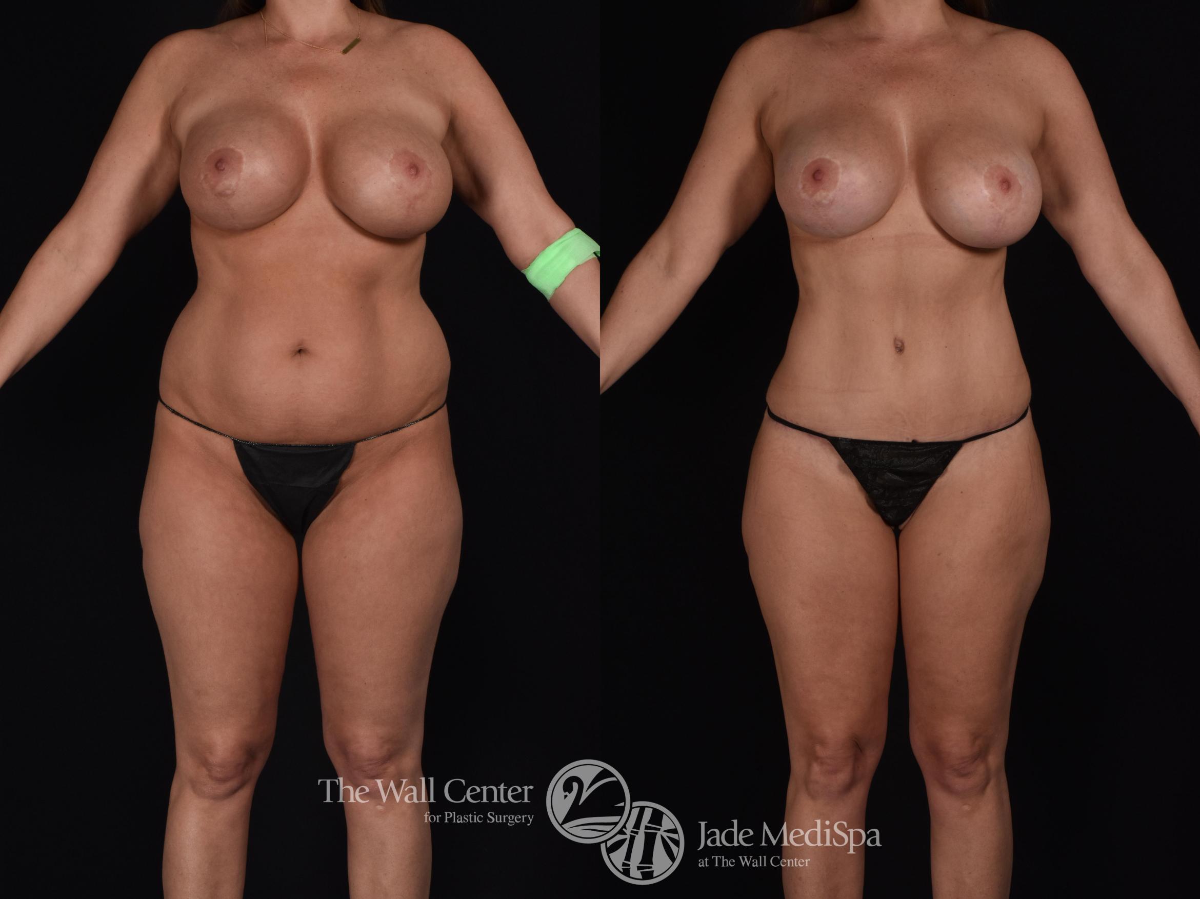 Before & After Tummy Tuck Case 570 View #1 View in Shreveport, LA