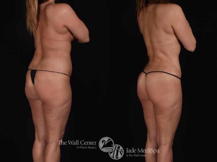 Before & After Tummy Tuck Case 570 View #4 View in Shreveport, LA