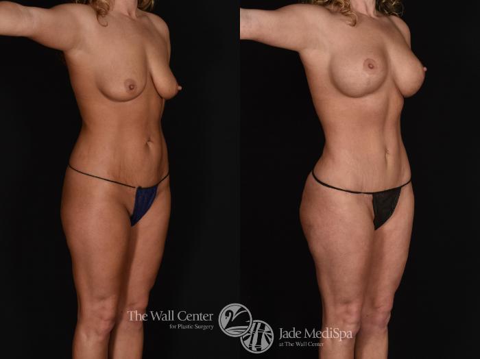 Before & After Tummy Tuck Case 677 VIEW #2 View in Shreveport, LA
