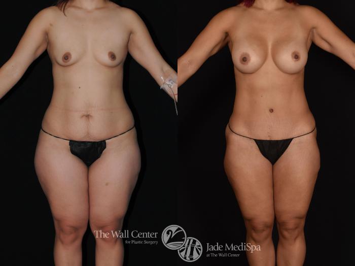 Before & After Tummy Tuck Case 719 VIEW #1 View in Shreveport, LA