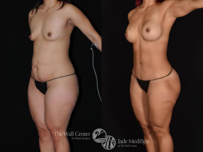 Before & After Tummy Tuck Case 719 VIEW #2 View in Shreveport, LA