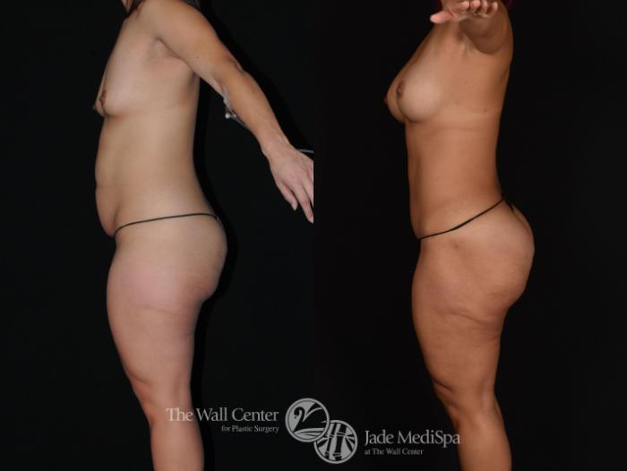 Before & After Tummy Tuck Case 719 VIEW #3 View in Shreveport, LA