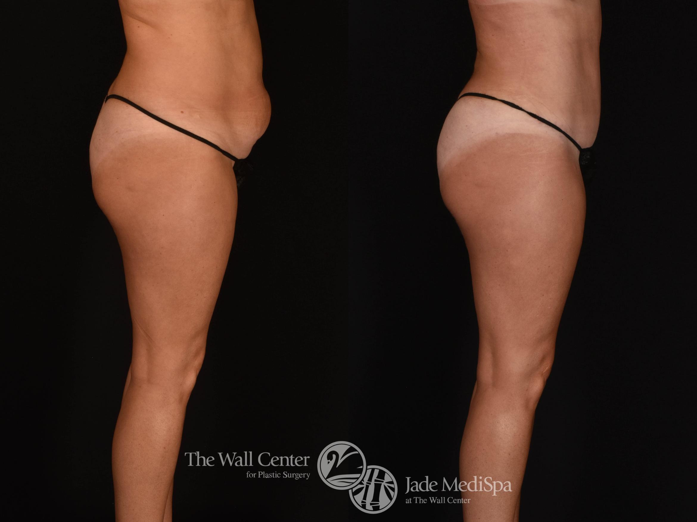 Abdominoplasty with SAFELipo Right Side Photo, Shreveport, LA, The Wall Center for Plastic Surgery, Case 932