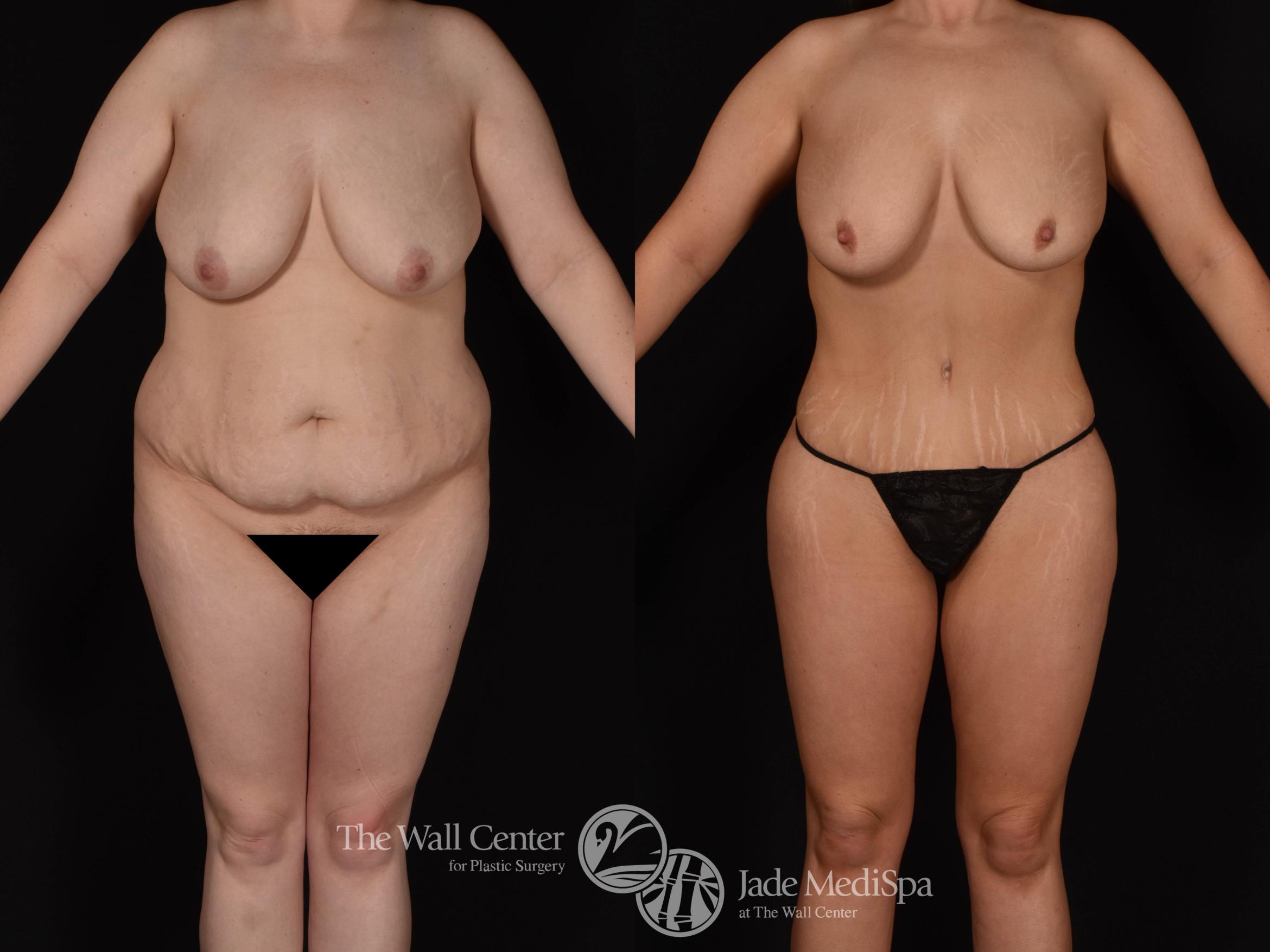 Abdominoplasty with SAFELipo Front Photo, Shreveport, LA, The Wall Center for Plastic Surgery, Case 970
