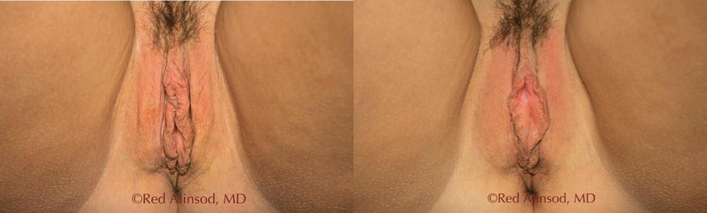 Before & After Vaginal Rejuvenation Case 511 View #1 View in Shreveport, LA