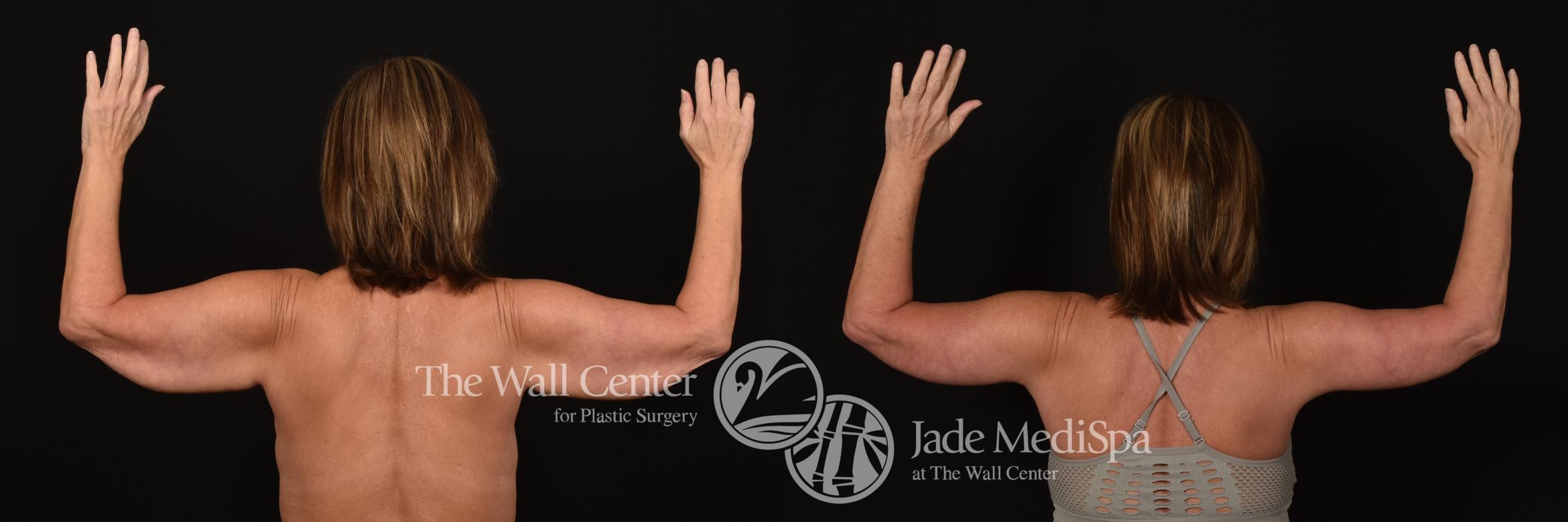 Before & After After Massive Weight Loss Case 1079 Back View in Shreveport, LA