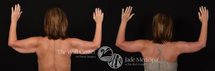 Before & After After Massive Weight Loss Case 1079 Back View in Shreveport, LA