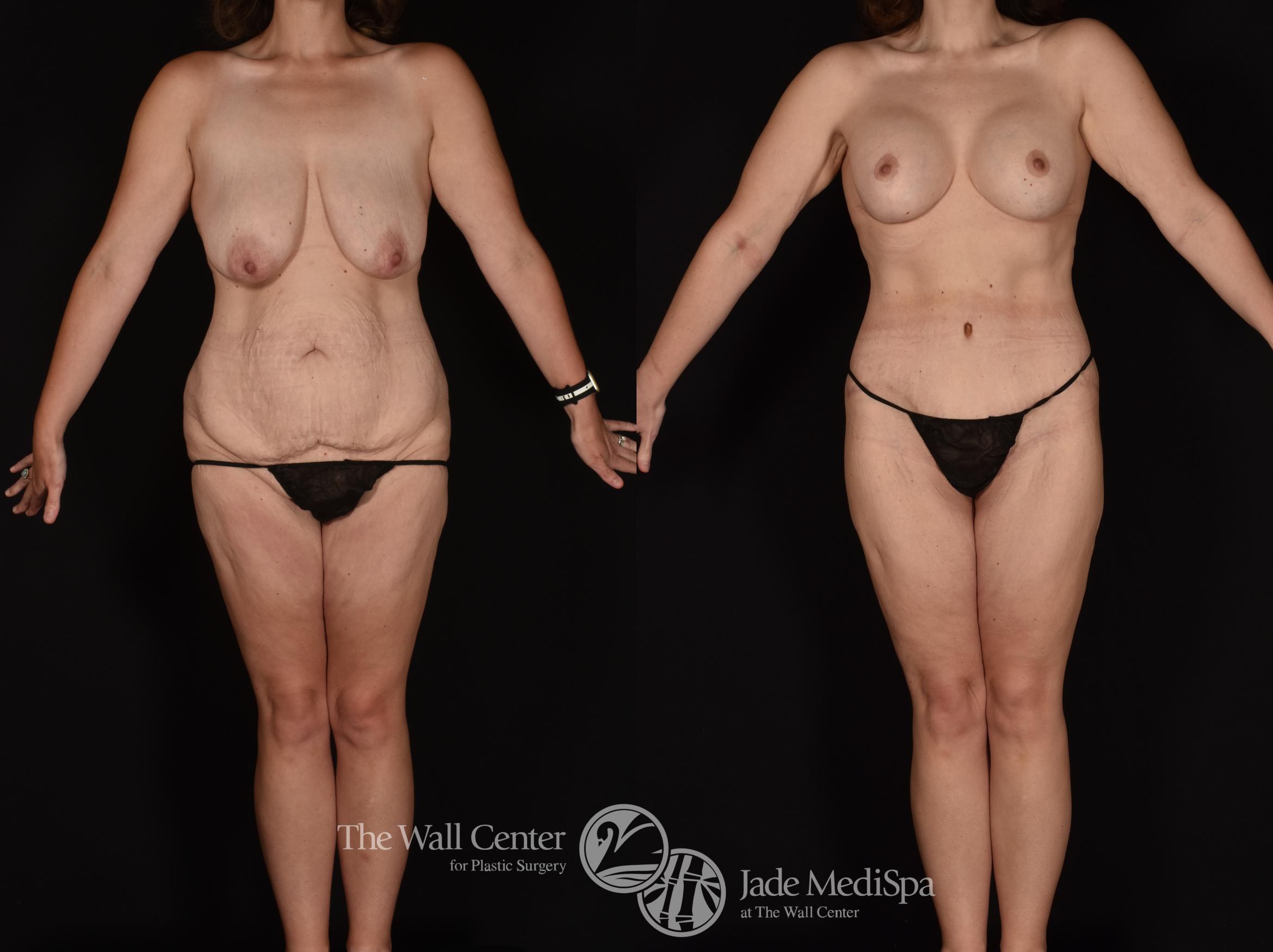 Before & After After Massive Weight Loss Case 1238 Front View in Shreveport, LA