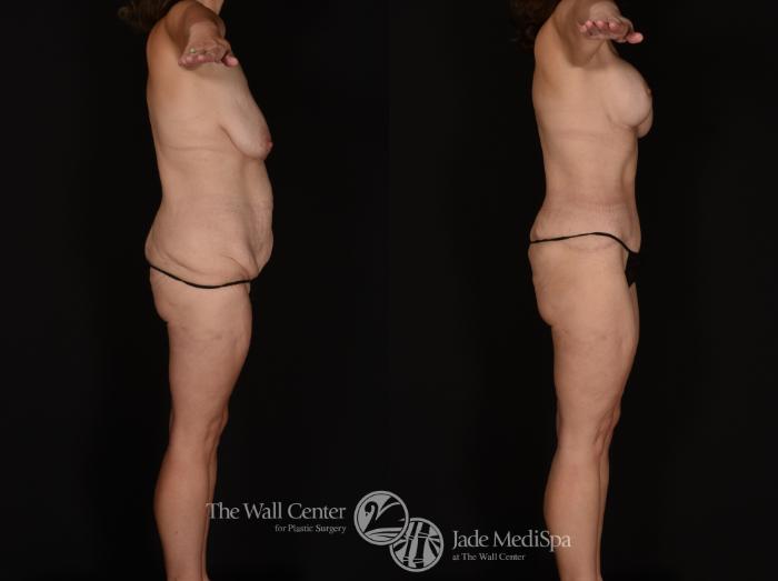 Before & After After Massive Weight Loss Case 1238 Right Side View in Shreveport, LA