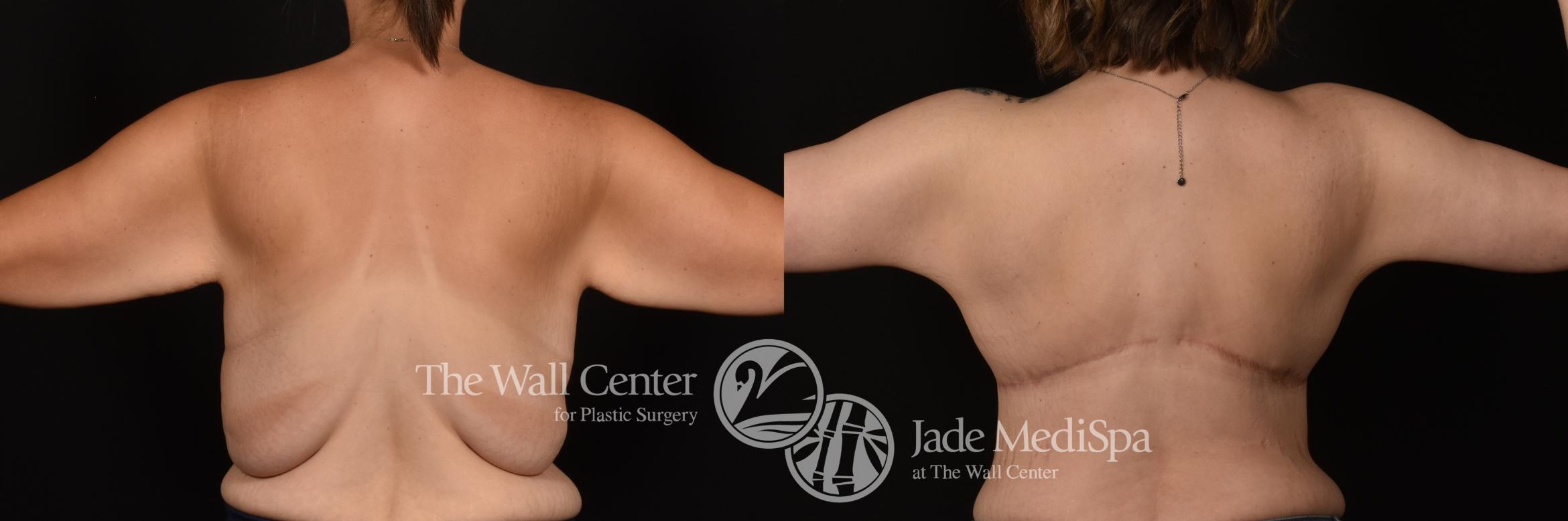 Before & After After Massive Weight Loss Case 1261 Back View in Shreveport, LA
