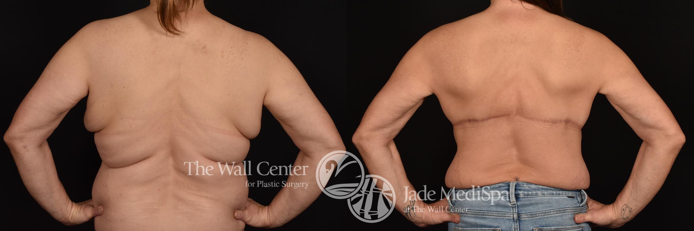 Before & After After Massive Weight Loss Case 1262 Back View in Shreveport, LA