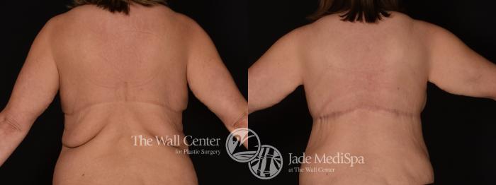 Before & After After Massive Weight Loss Case 1263 Back View in Shreveport, LA