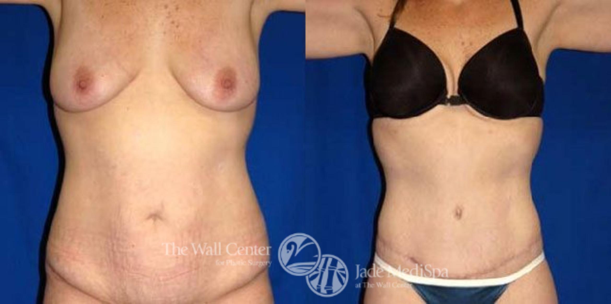 Before & After After Massive Weight Loss Case 175 View #1 View in Shreveport, LA