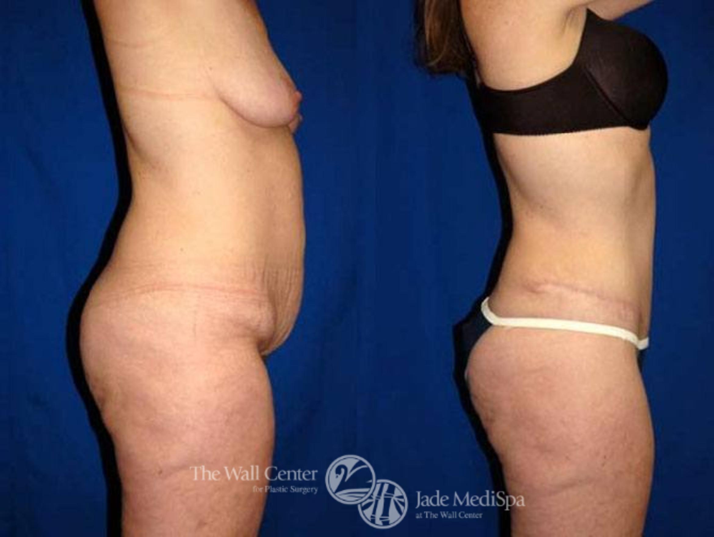 Before & After After Massive Weight Loss Case 175 View #3 View in Shreveport, LA