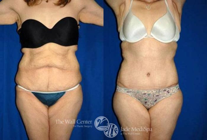 Before & After After Massive Weight Loss Case 176 View #1 View in Shreveport, LA