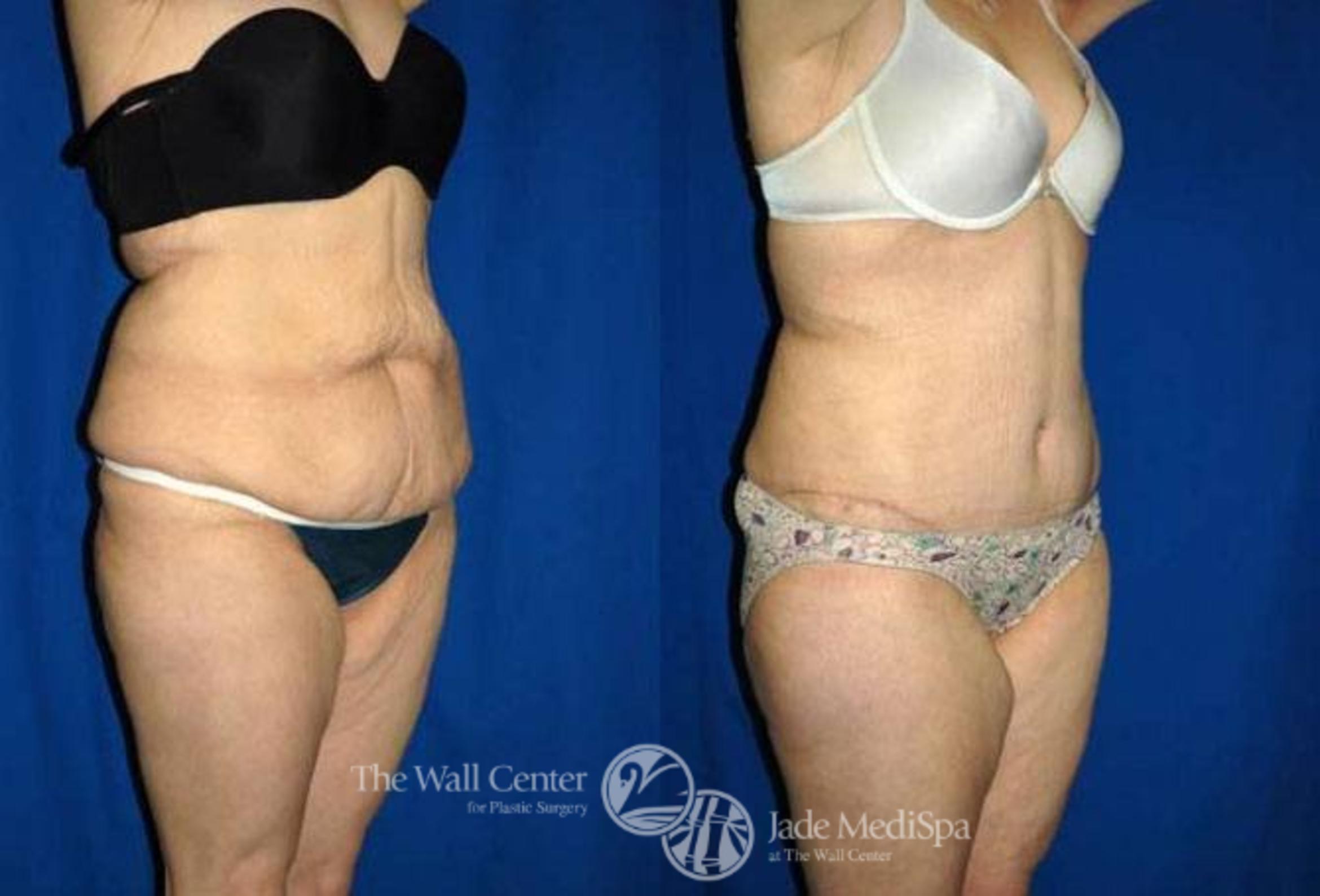 Before & After After Massive Weight Loss Case 176 View #2 View in Shreveport, LA