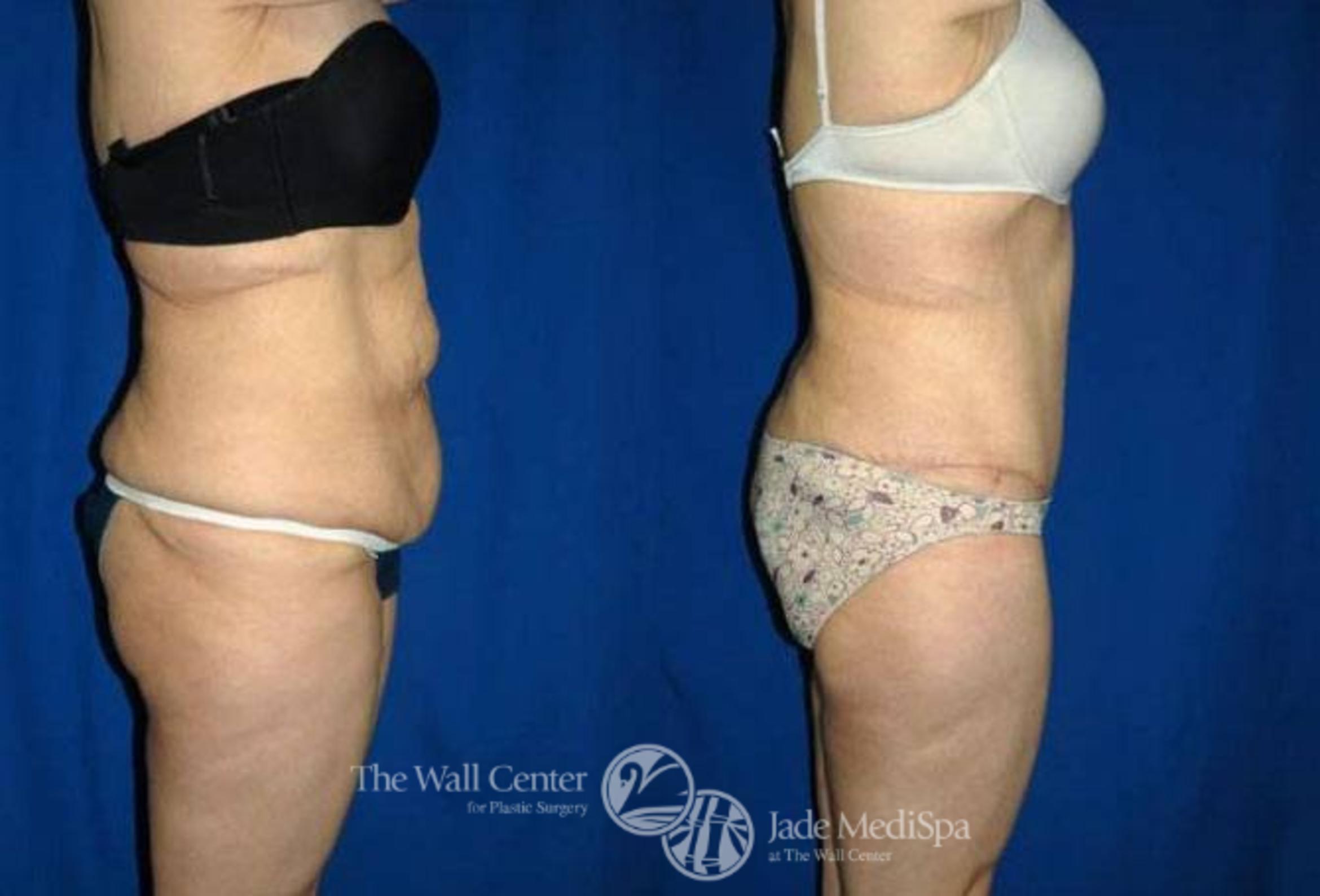 Before & After After Massive Weight Loss Case 176 View #3 View in Shreveport, LA
