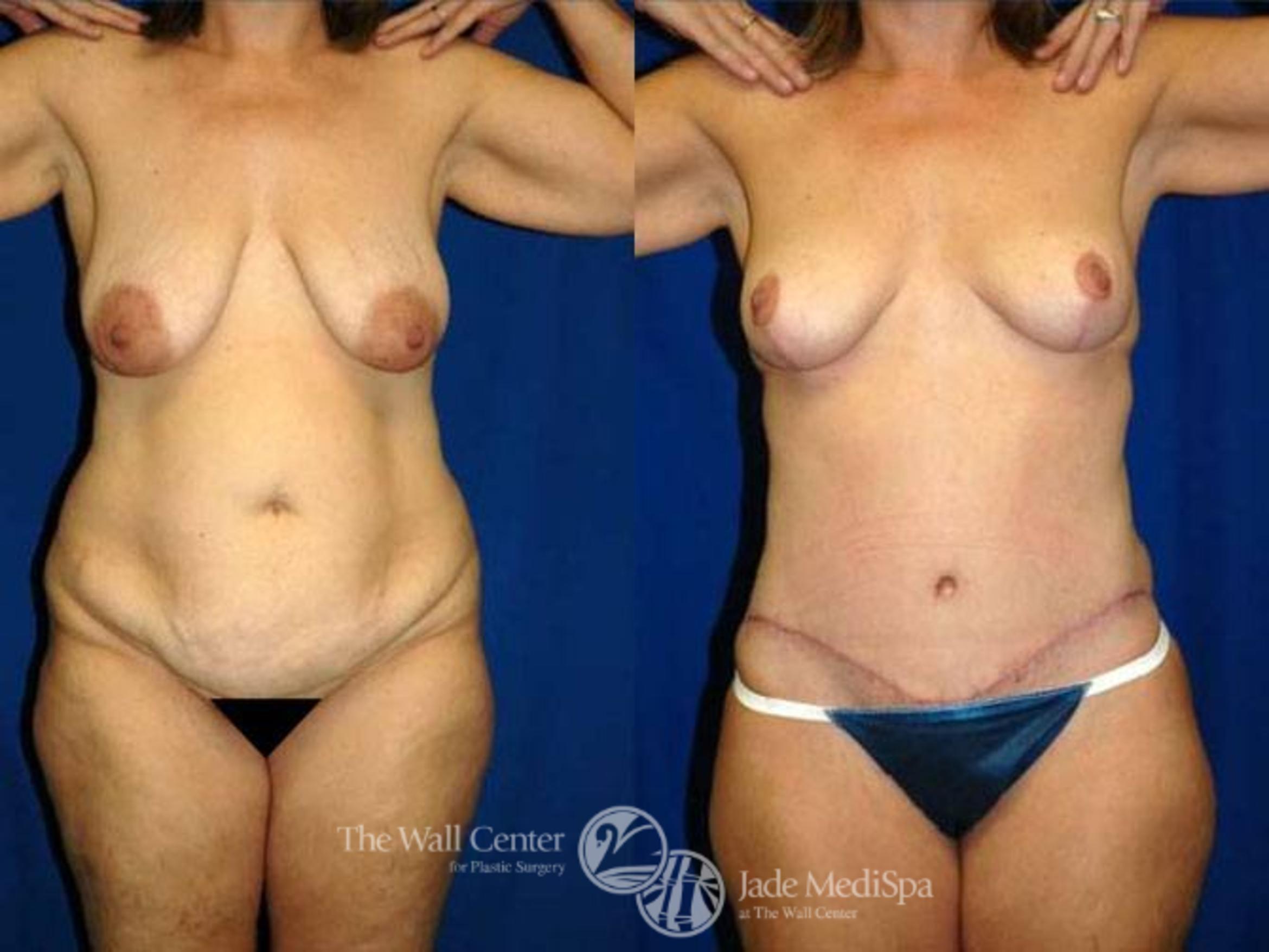 Before & After After Massive Weight Loss Case 177 View #1 View in Shreveport, LA