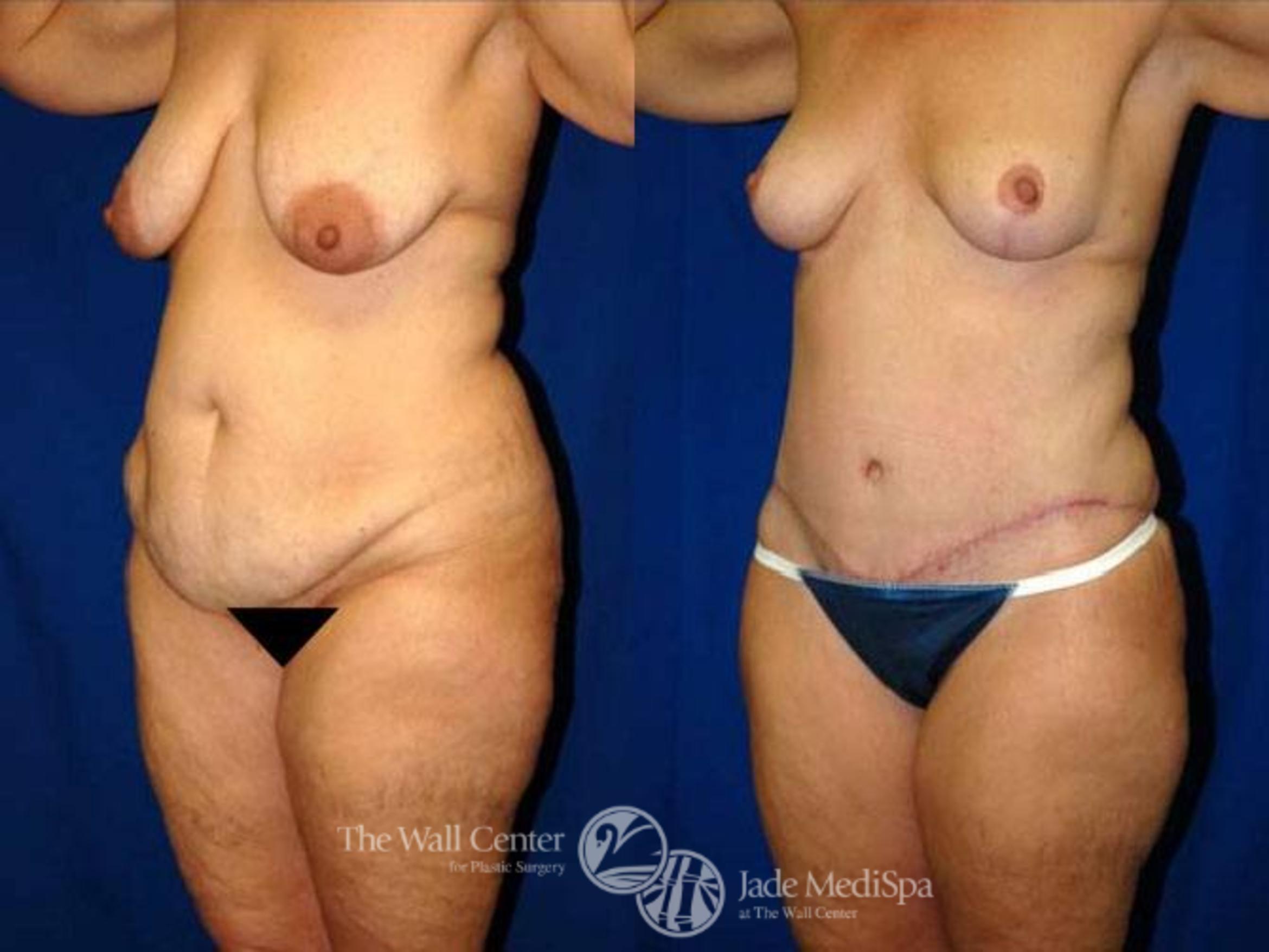 Before & After After Massive Weight Loss Case 177 View #2 View in Shreveport, LA