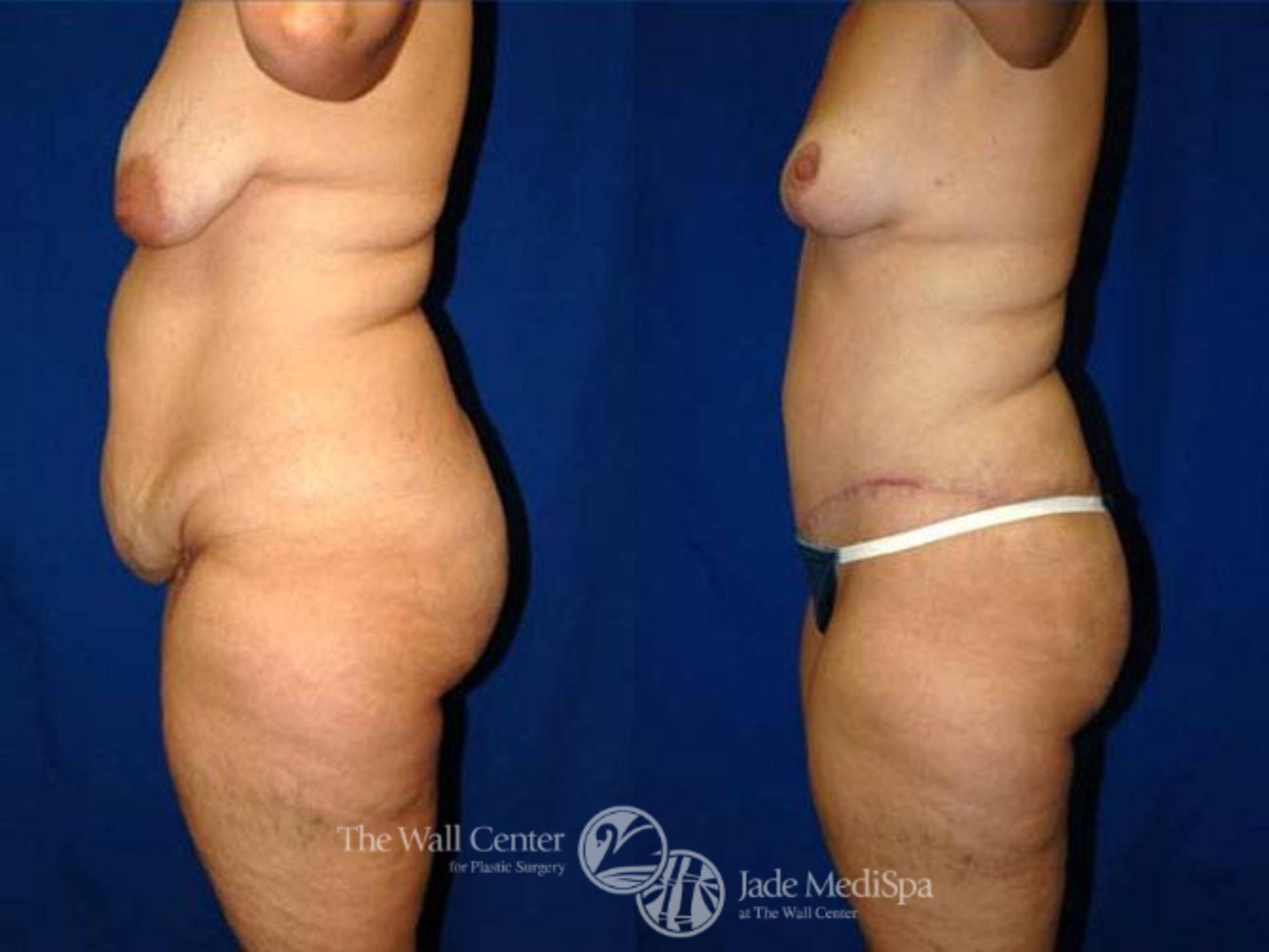 Before & After After Massive Weight Loss Case 177 View #3 View in Shreveport, LA