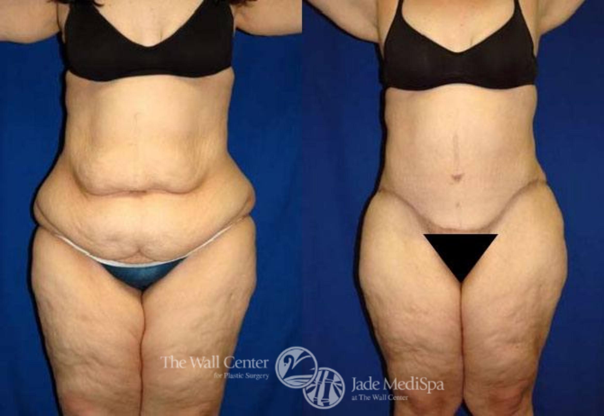 Before & After After Massive Weight Loss Case 181 View #1 View in Shreveport, LA