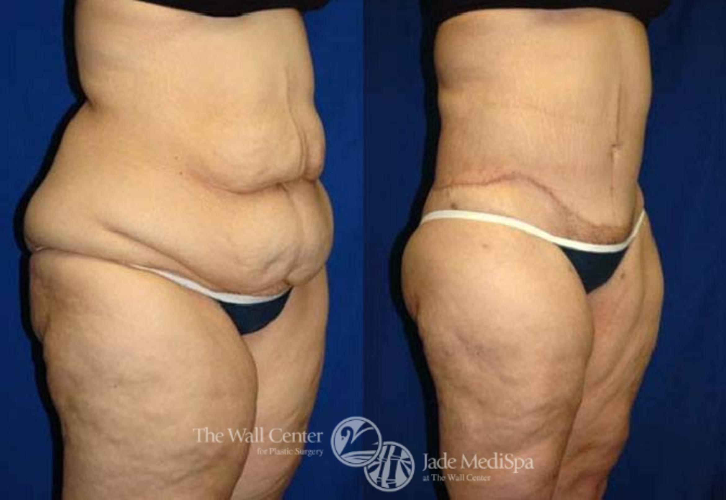 Before & After After Massive Weight Loss Case 181 View #2 View in Shreveport, LA