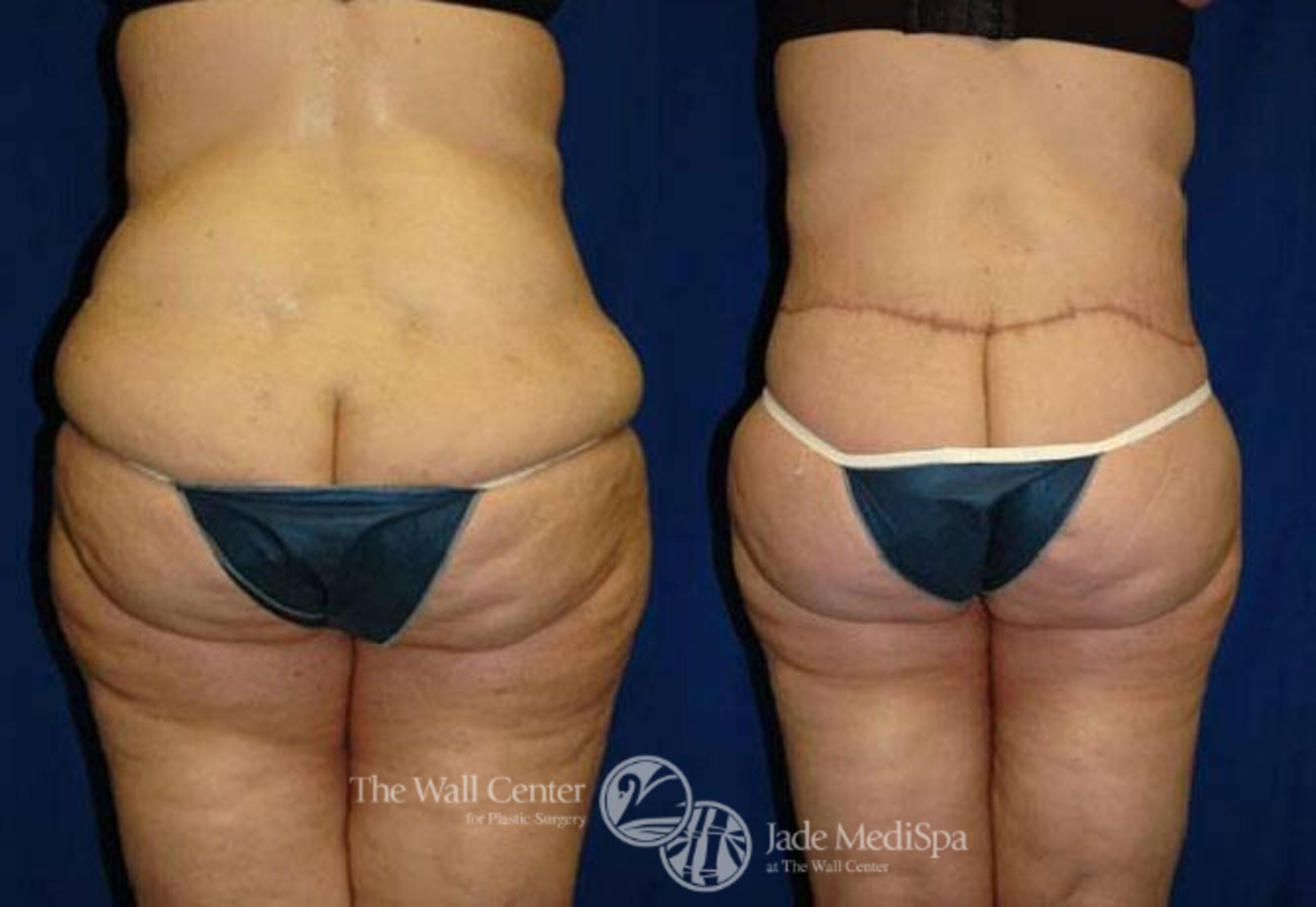 Before & After After Massive Weight Loss Case 181 View #4 View in Shreveport, LA