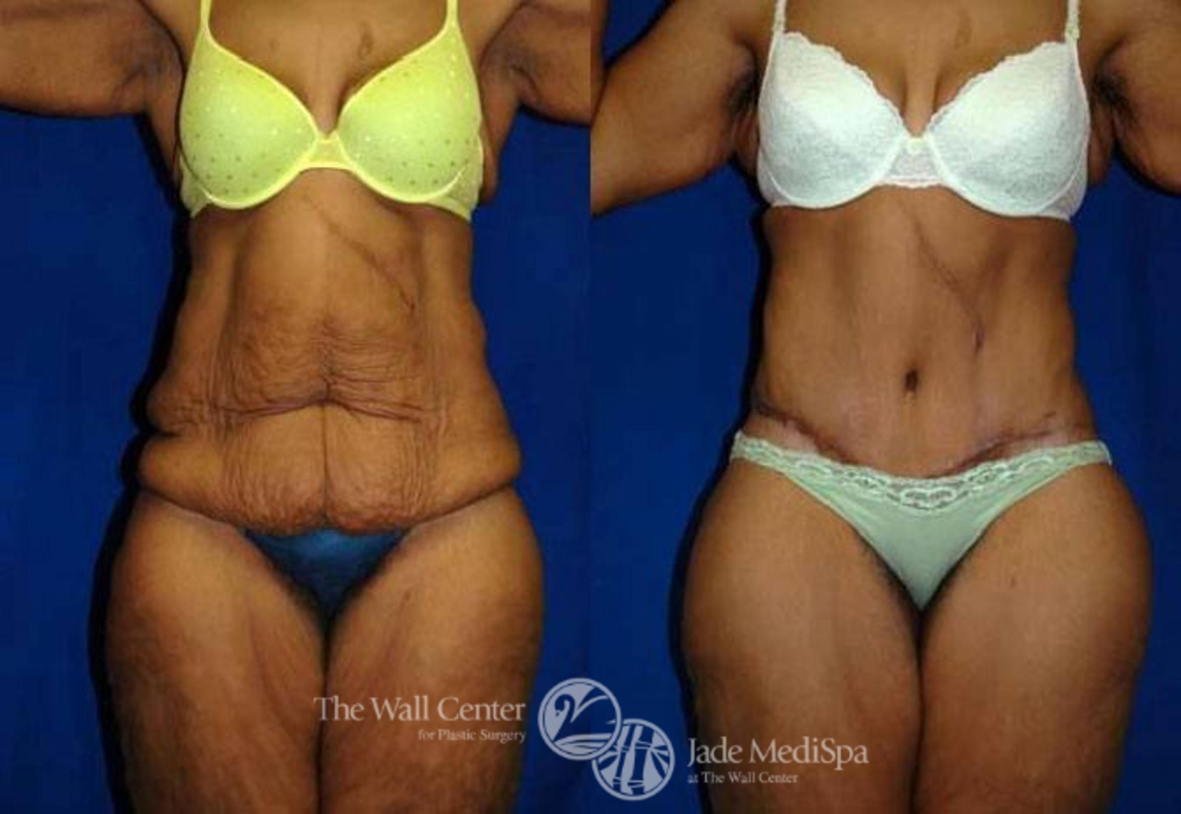 Before & After After Massive Weight Loss Case 182 View #1 View in Shreveport, LA
