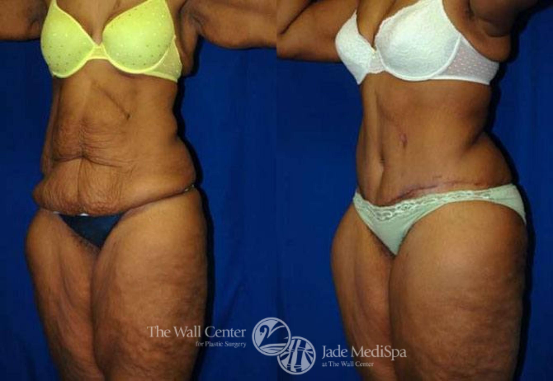 Before & After After Massive Weight Loss Case 182 View #2 View in Shreveport, LA