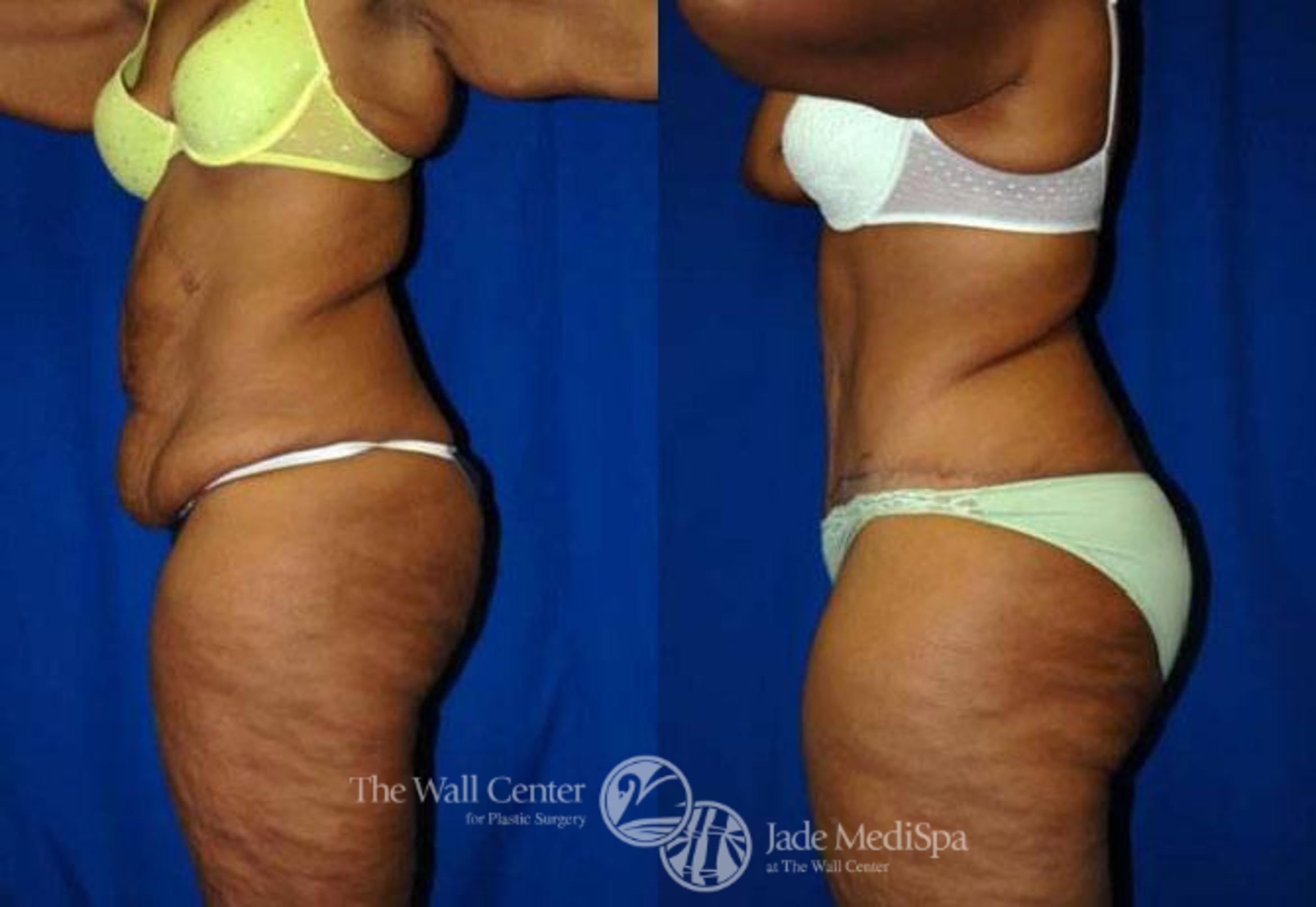 Before & After After Massive Weight Loss Case 182 View #3 View in Shreveport, LA