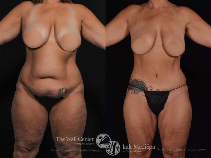 Before & After After Massive Weight Loss Case 534 View #1 View in Shreveport, LA