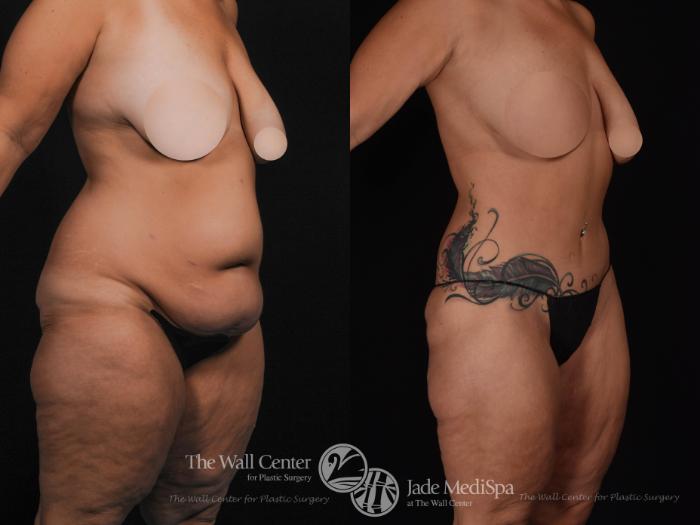 Before & After After Massive Weight Loss Case 534 View #2 View in Shreveport, LA