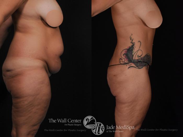 Before & After After Massive Weight Loss Case 534 View #3 View in Shreveport, LA
