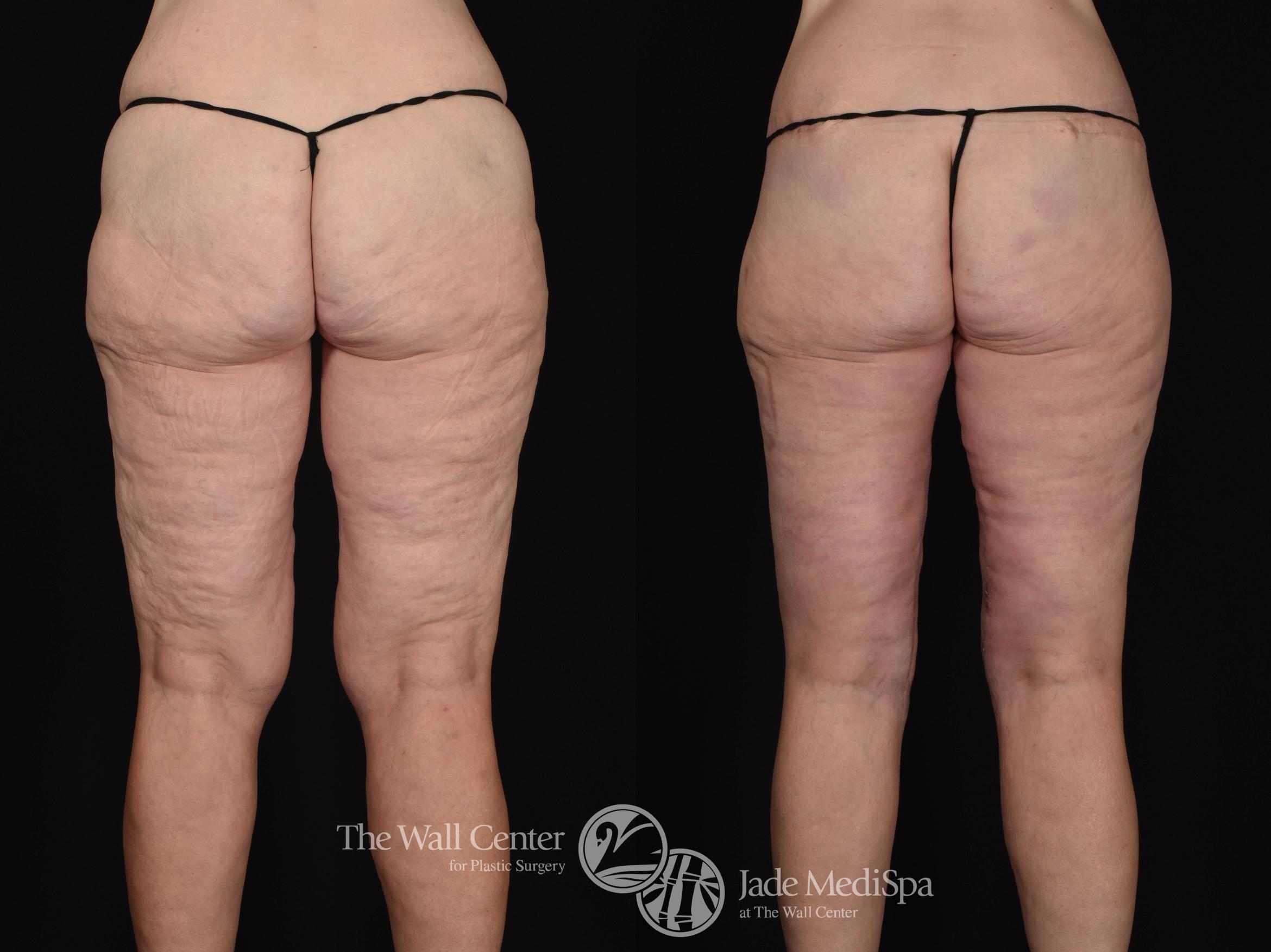 Before & After After Massive Weight Loss Case 662 VIEW #2 View in Shreveport, LA