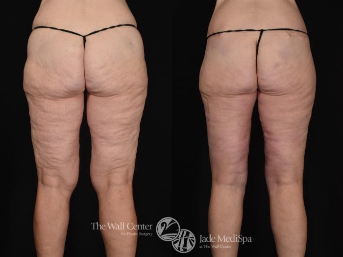 Before & After After Massive Weight Loss Case 662 VIEW #2 View in Shreveport, LA