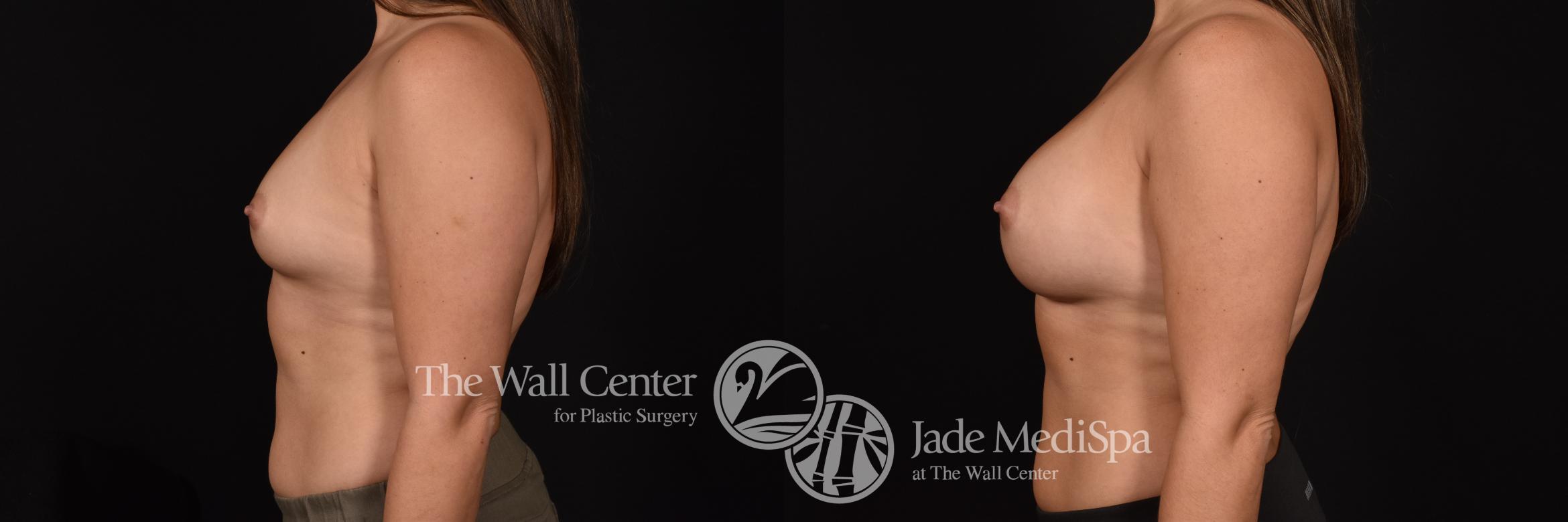 Before & After Breast Augmentation Case 1004 Left Side View in Shreveport, LA