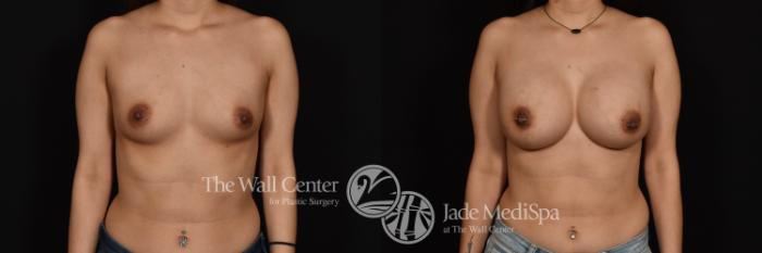 Before & After Breast Augmentation Case 1006 Front View in Shreveport, LA