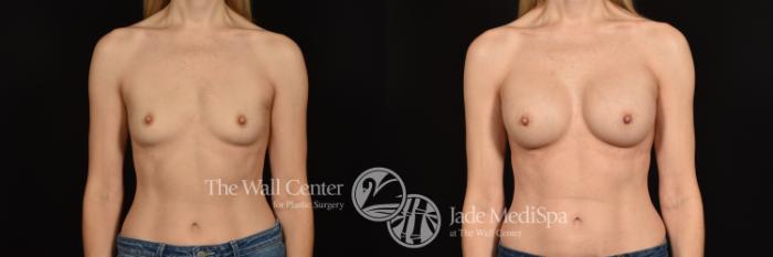 Before & After Breast Augmentation Case 1011 Front View in Shreveport, LA