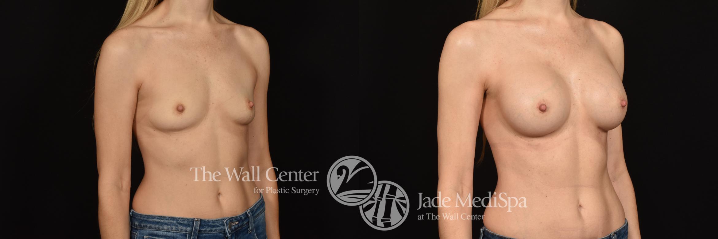 Before & After Breast Augmentation Case 1011 Right Oblique View in Shreveport, LA