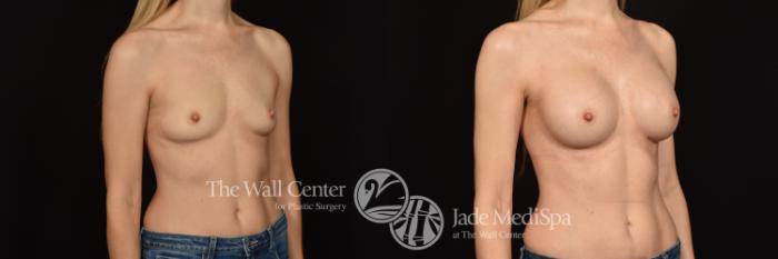 Before & After Breast Augmentation Case 1011 Right Oblique View in Shreveport, LA