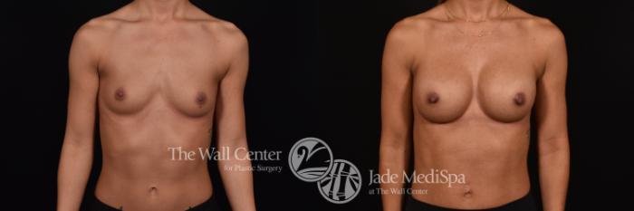 Before & After Breast Augmentation Case 1029 Front View in Shreveport, LA