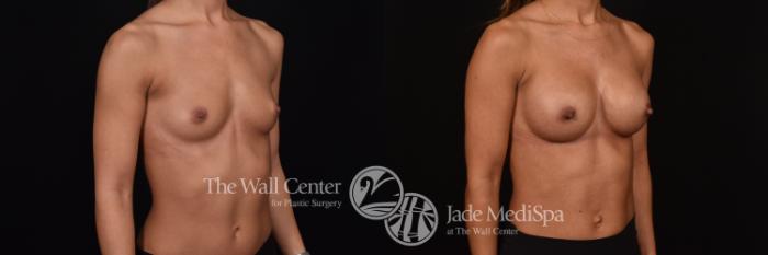Before & After Breast Augmentation Case 1029 Right Oblique View in Shreveport, LA