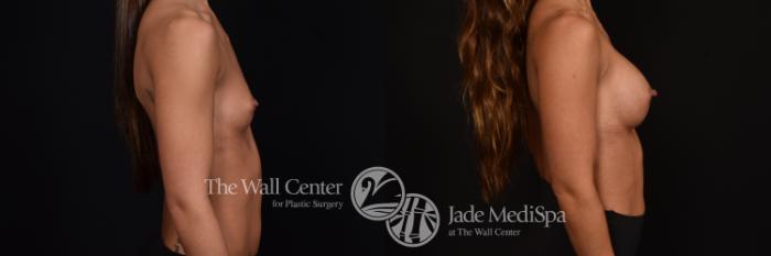 Before & After Breast Augmentation Case 1029 Right Side View in Shreveport, LA