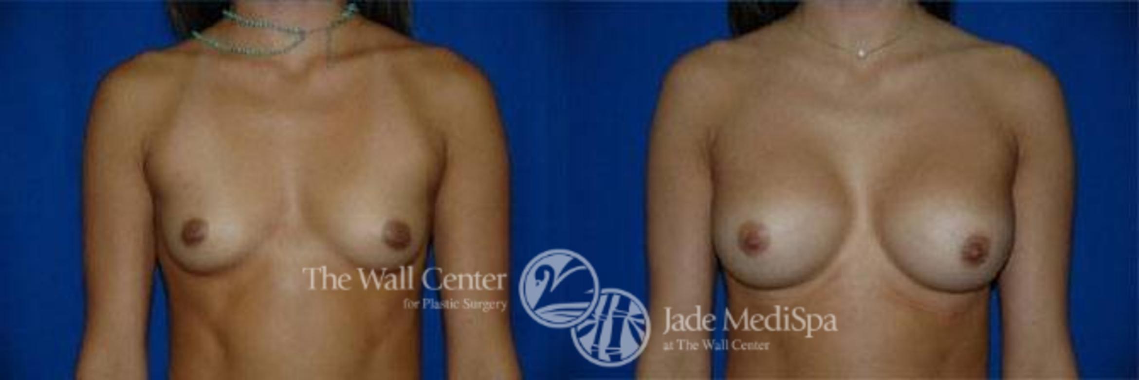 Before & After Breast Augmentation Case 103 View #1 View in Shreveport, LA