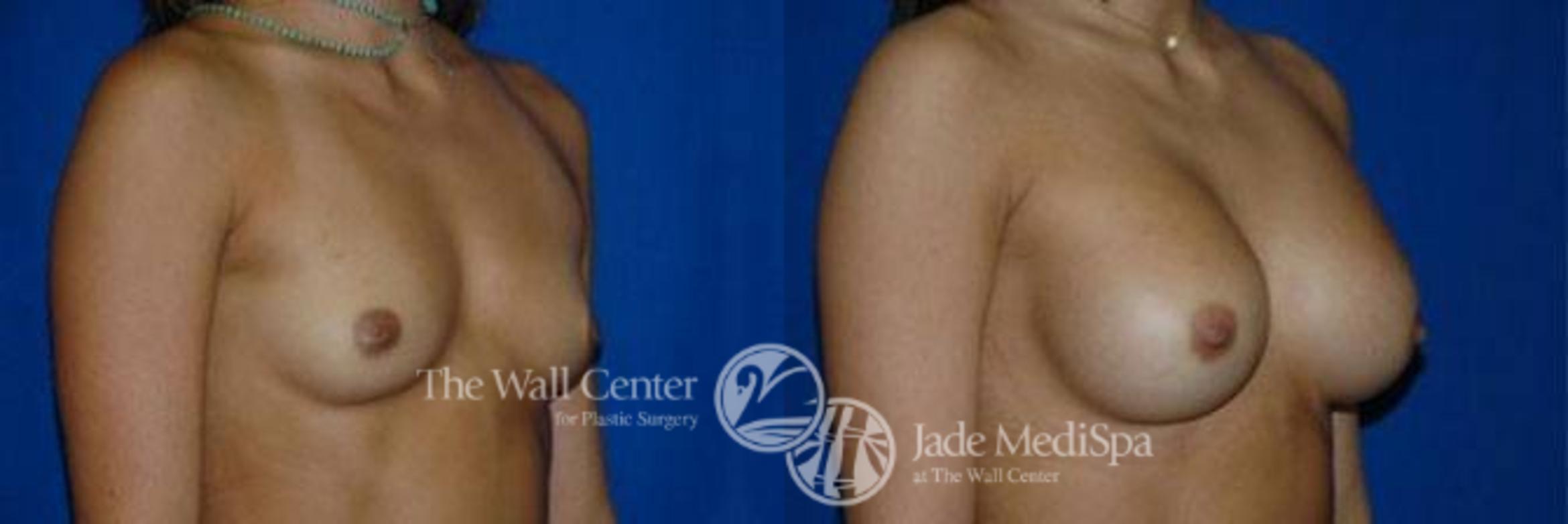 Before & After Breast Augmentation Case 103 View #2 View in Shreveport, LA