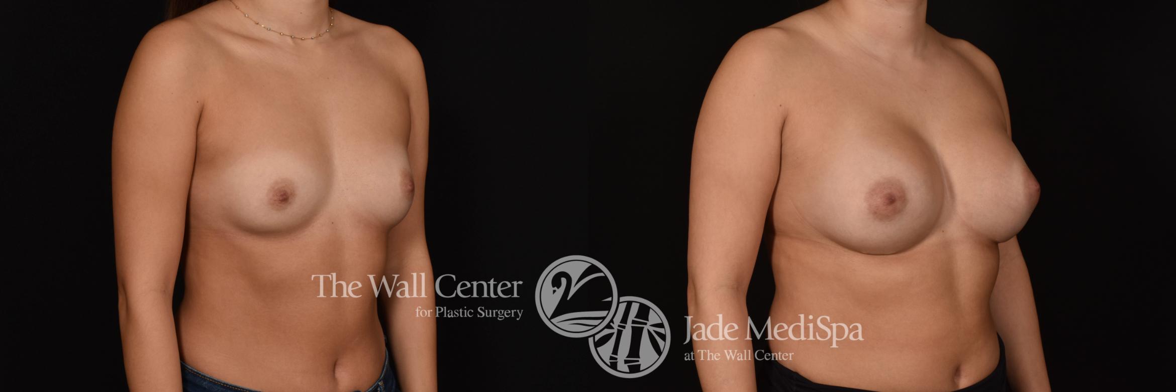 Before & After Breast Augmentation Case 1032 Right Oblique View in Shreveport, LA